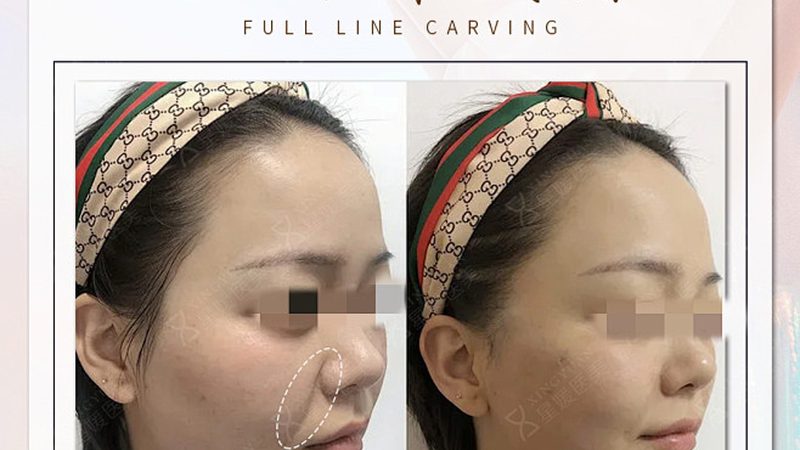 热玛吉：揭秘其效果背后的科学原理