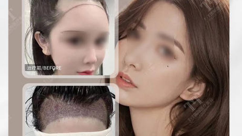 玻尿酸VS自体脂肪：填充塑形，哪种更胜一筹？**
