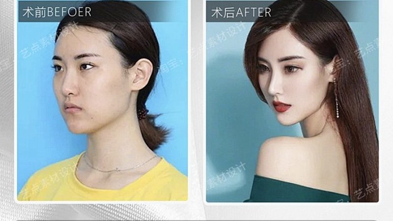广州割双眼皮公立医院与私立医院区别