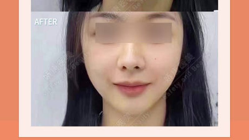激光美容仪器：揭秘美容仪器批发市场的“激光密码
