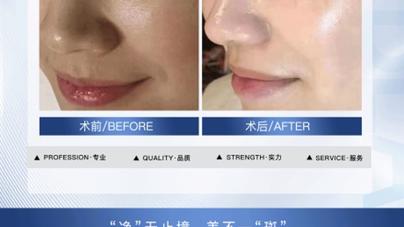 肉毒素去抬头纹，安全吗？揭秘注射细节与注意事项