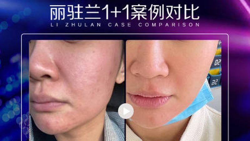玻尿酸批发价格揭秘：如何选择性价比之选？**