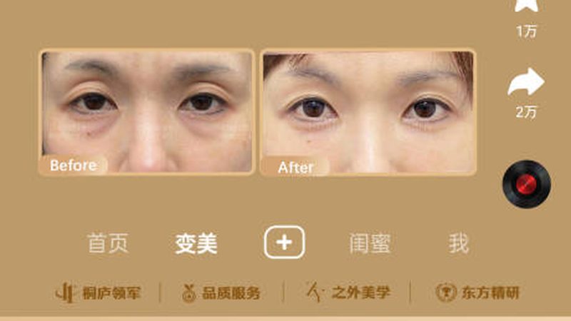 成都自体软骨隆鼻：了解其优势与注意事项